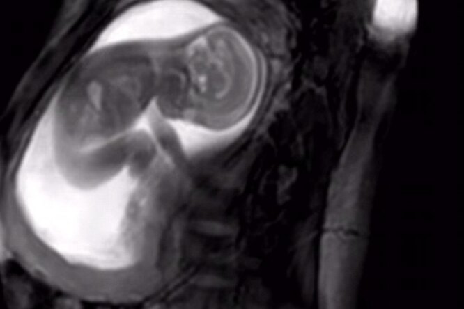 Невероятно четкие снимки младенца в утробе — революция в МРТ