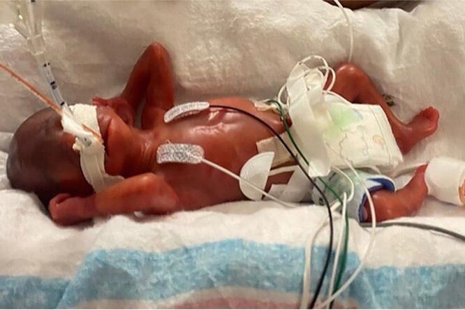 В Алабаме родился самый недоношенный малыш в мире. Но врачи сотворили чудо