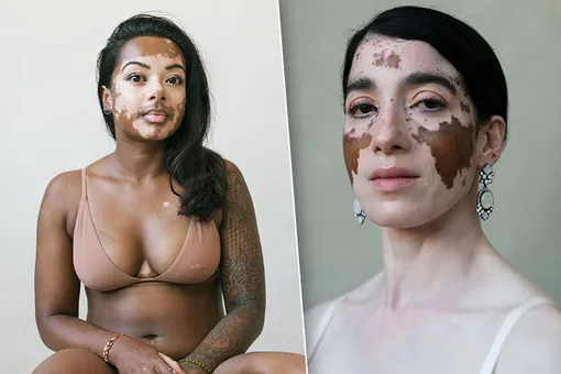 «Путь принятия пятен»: фотограф с витилиго нашла моделей с таким же недостатком кожи