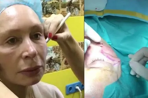 69-летняя Татьяна Васильева подверглась жуткой процедуре по омоложению лица