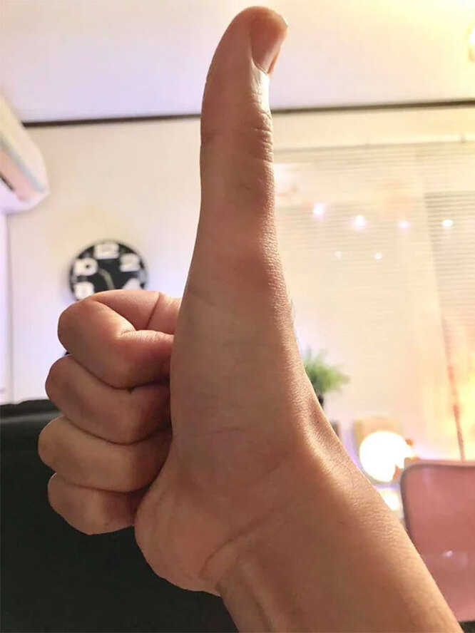 Аномально длинный большой палец